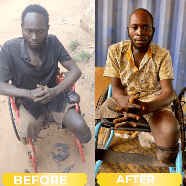 Before and after wheelchair support case 3